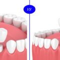 implant sau punte dentara?