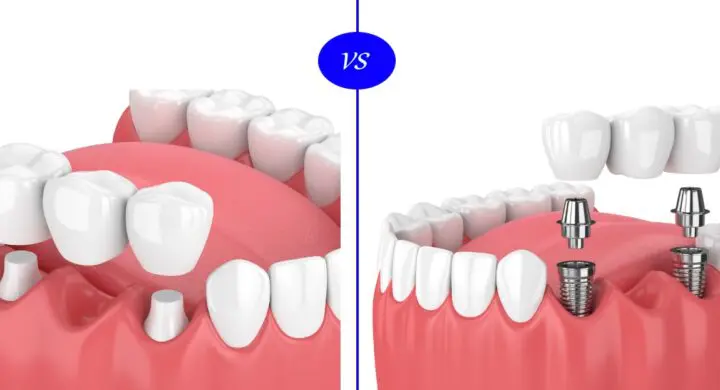 implant sau punte dentara?
