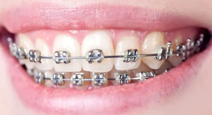 De ce sa alegi un aparat dentar? Avantajele aparatelor dentare