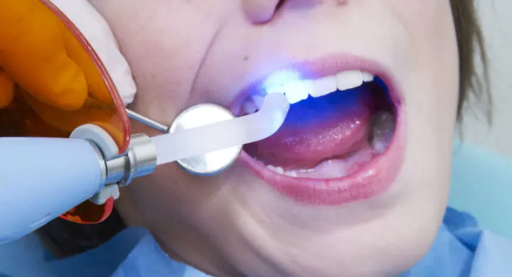 Importanta sigilarilor dentare