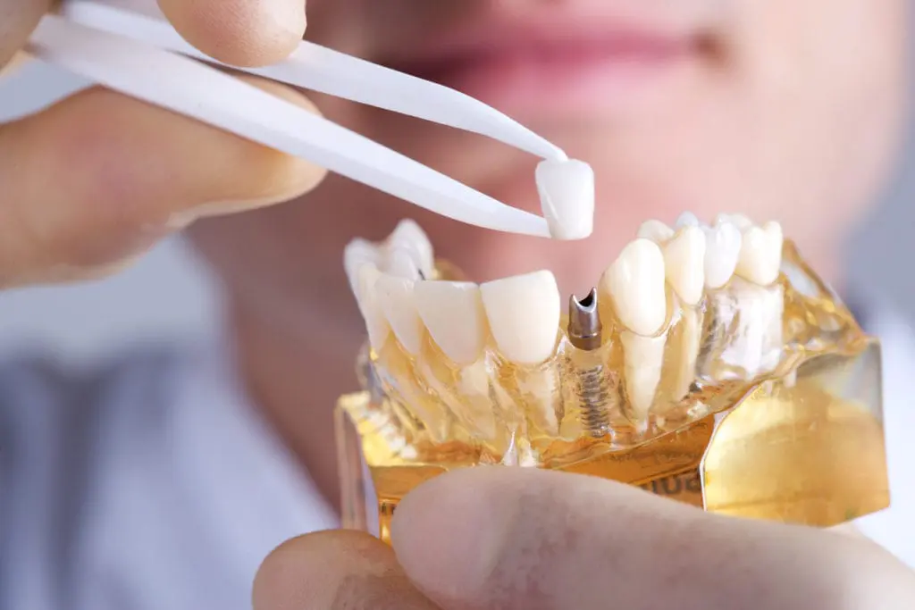 Avantajele implantului dentar fata de alte solutii de reabilitare orala