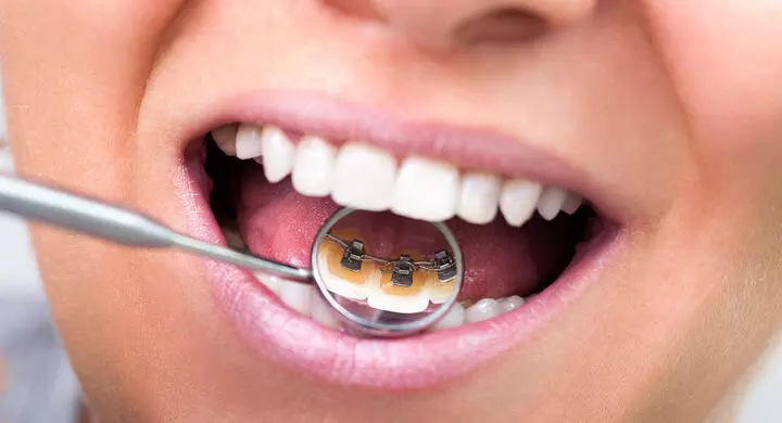 Tratamente ortodontice pentru adulti