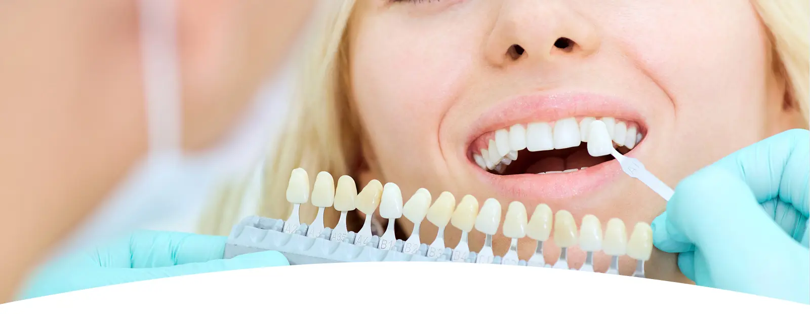 Mituri despre fatetele dentare