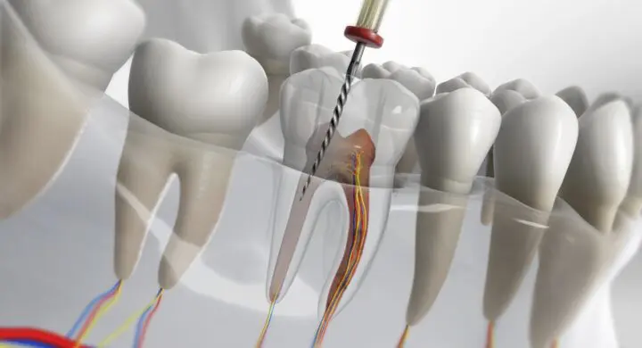 Mituri despre tratamentul endodontic