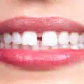 Diastema sau strungareata dentara