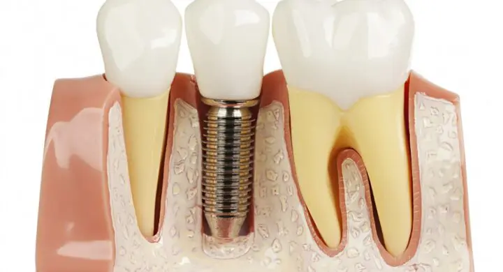 Implantul dentar – Redescopera bucuria de a zambi
