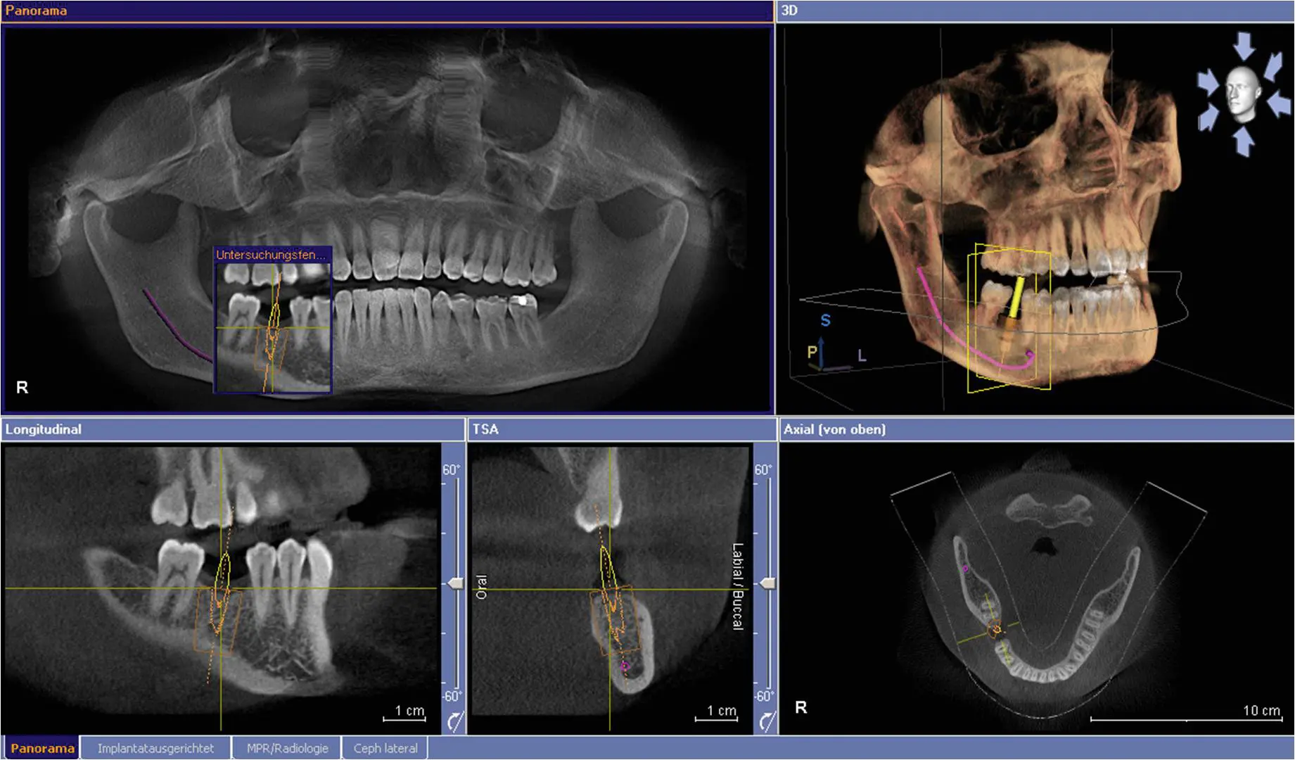 Cum se evalueaza osul in cazul inserarii unui implant dentar?