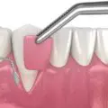 Grefa gingivala pe implantul dentar