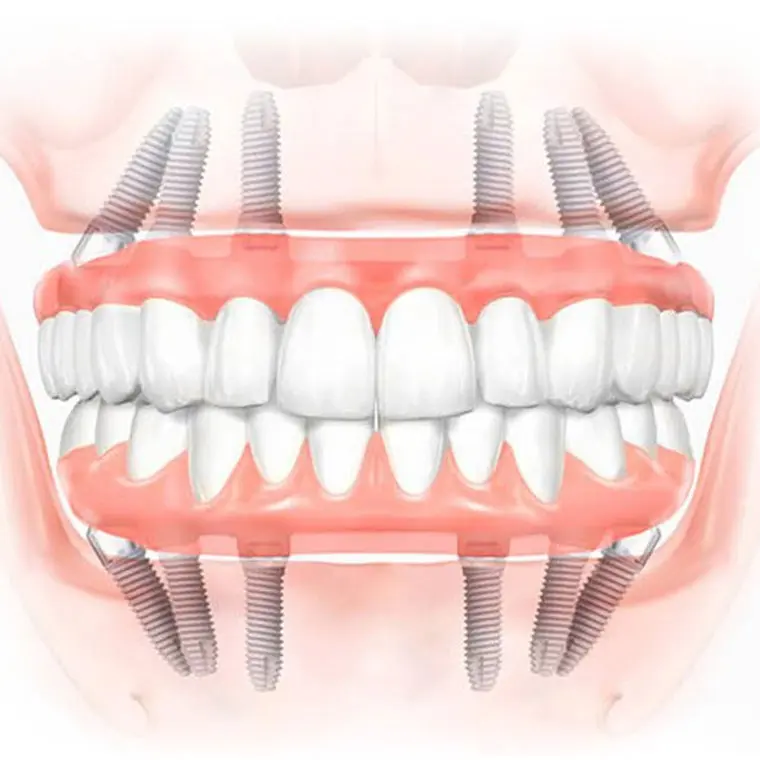 Parodontoza si implanturile dentare
