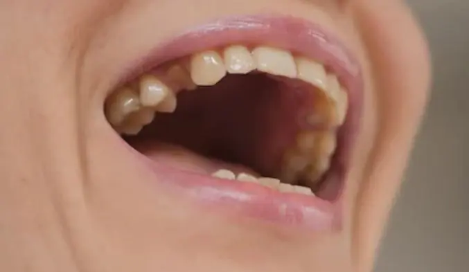 Ce cauze duc la pierderea dintilor?