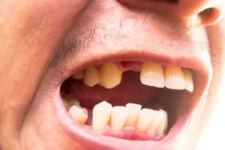 Cauzele pierderii dintilor