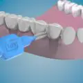 implant dentar igiena