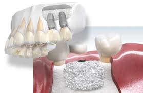 aditie ososa pentru implant dentar