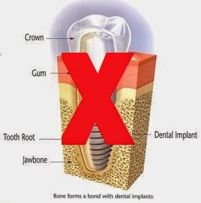 implant dentar contraindicatii absolute