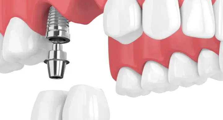 contraindicatii implant dentar