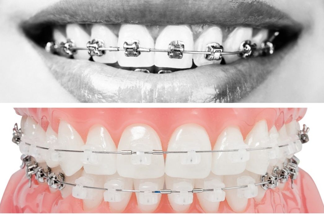 Aparat dentar ceramic versus aparat dentar metalic sau aparat dentar safir