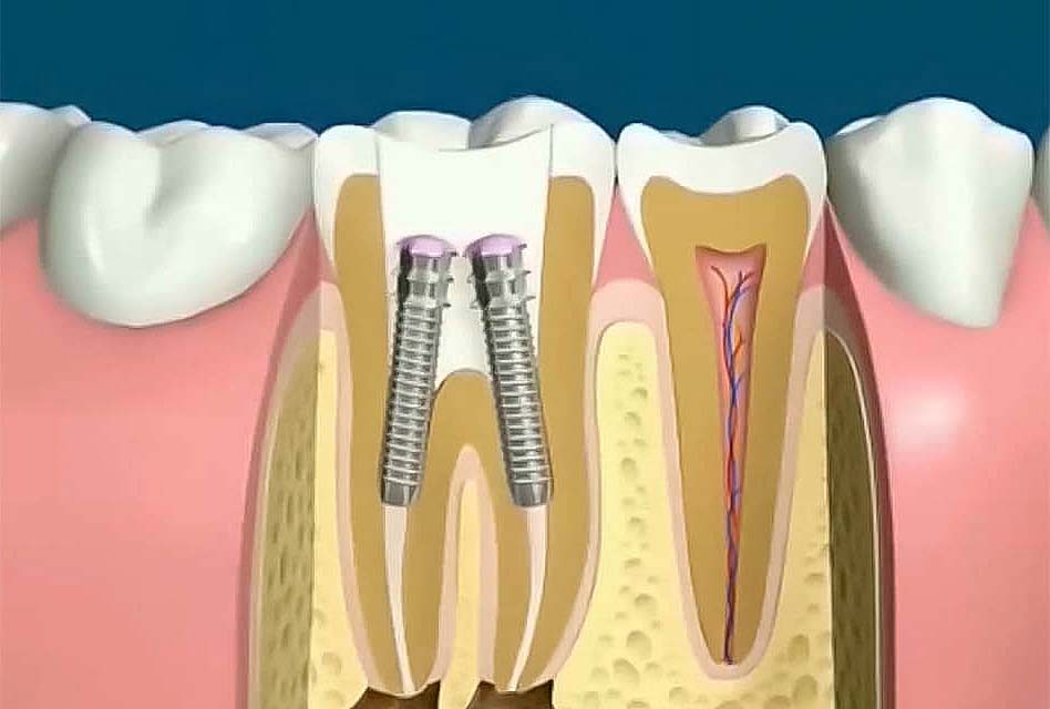pivot dentar cu doua radacini