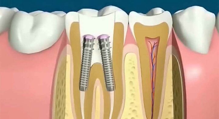 Pivotul dentar: caracteristici, tipuri, rol, indicatii