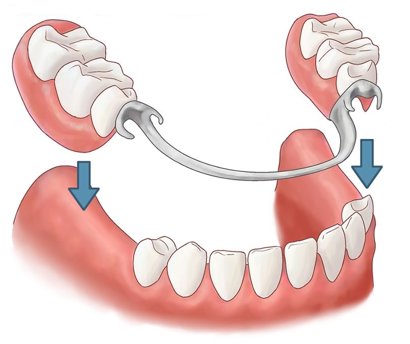proteza dentara