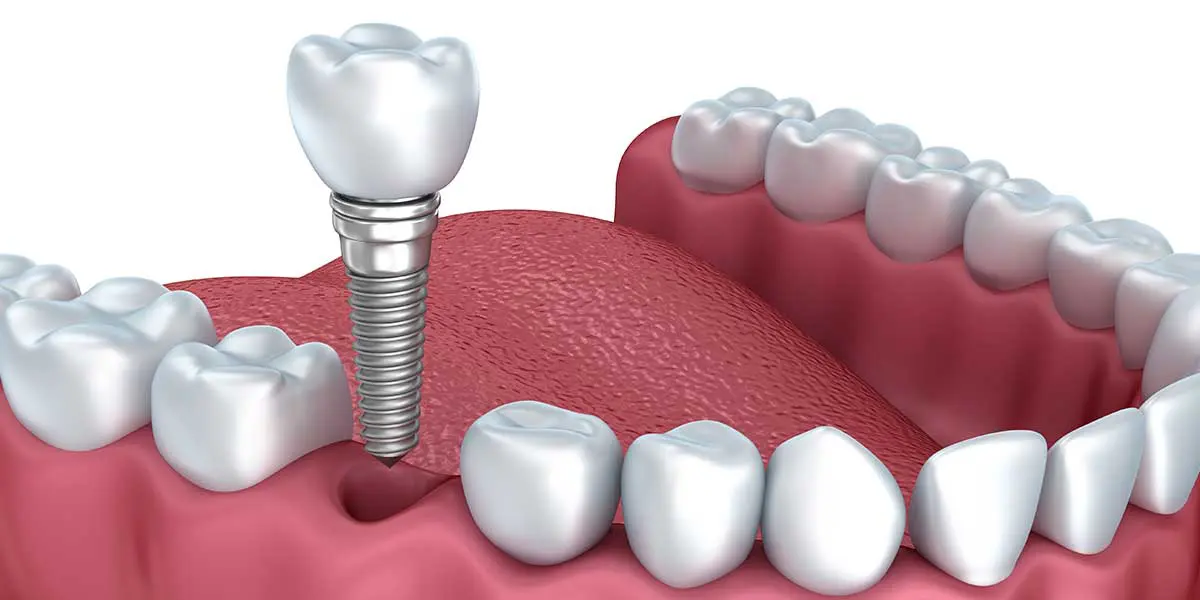 coroana dentara pe implant