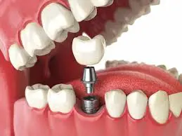 Coroana dentara pe implant dentar