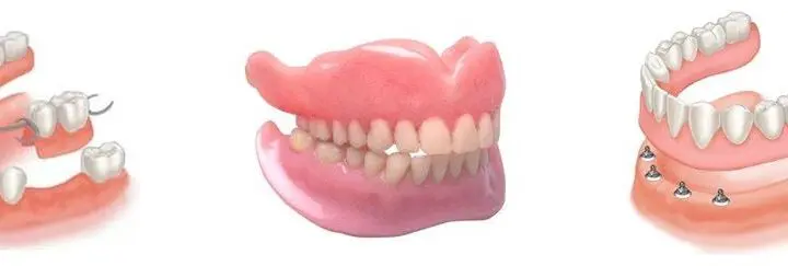 implant dentar sau proteza dentara?