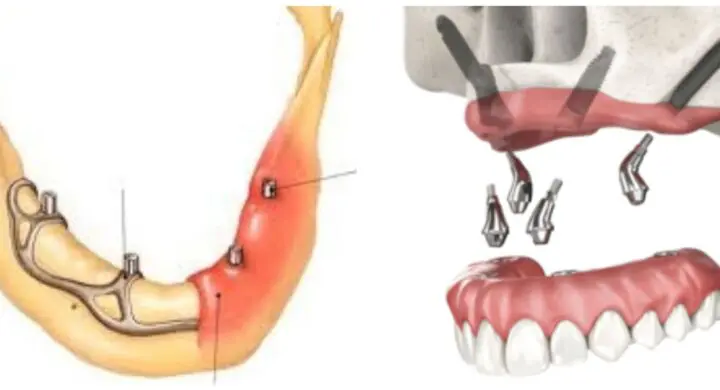 implanturi zigomatice sau subperiostale