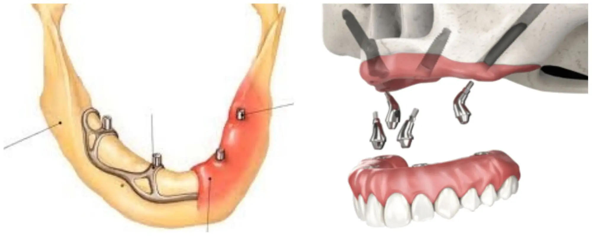 implanturi zigomatice sau subperiostale