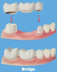 punte dentara traditionala clasica