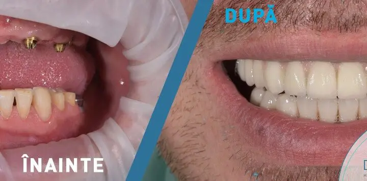 Pacient 38 ani - Restaurare dentara totala la maxilar si mandibula: lucrari fixe pe implanturi, coroane si fatete dentare integral ceramice