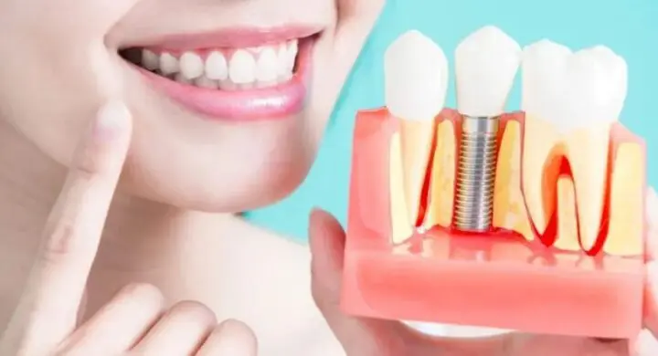 lucrari dentare pe implanturi
