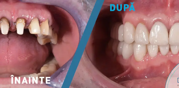 Pacient 50 ani - Restaurarea totala a danturii la maxilar si mandibula: implanturi dentare, coroane si fatete integral ceramice