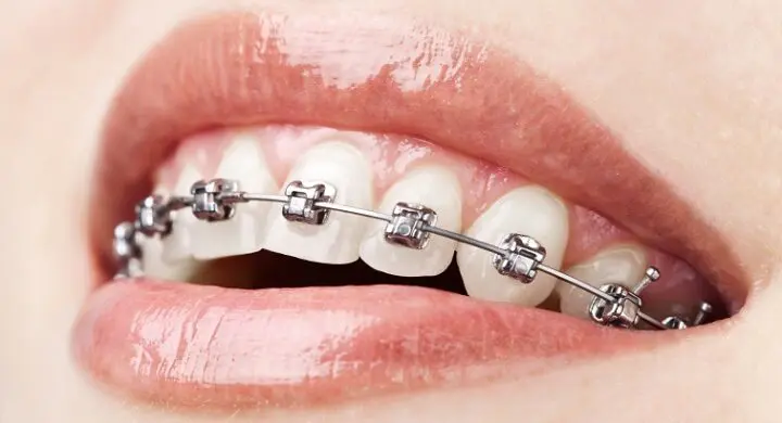 4 sfaturi pentru viata cu aparatul dentar