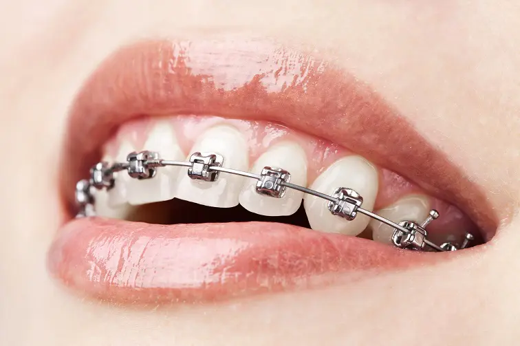 4 sfaturi pentru viata cu aparatul dentar