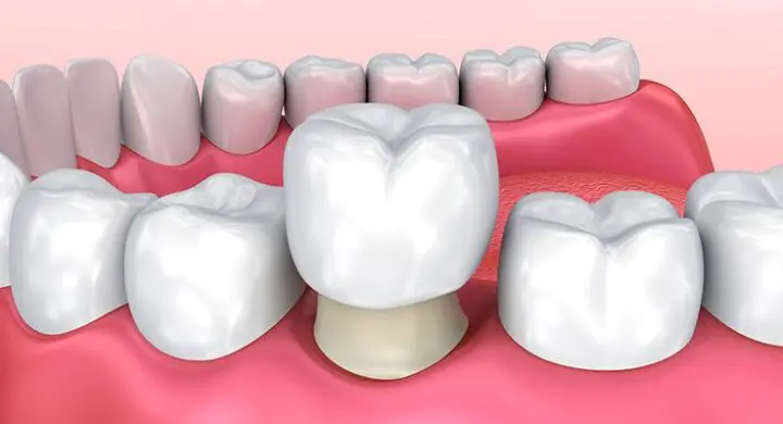 coroana dentara integral ceramica