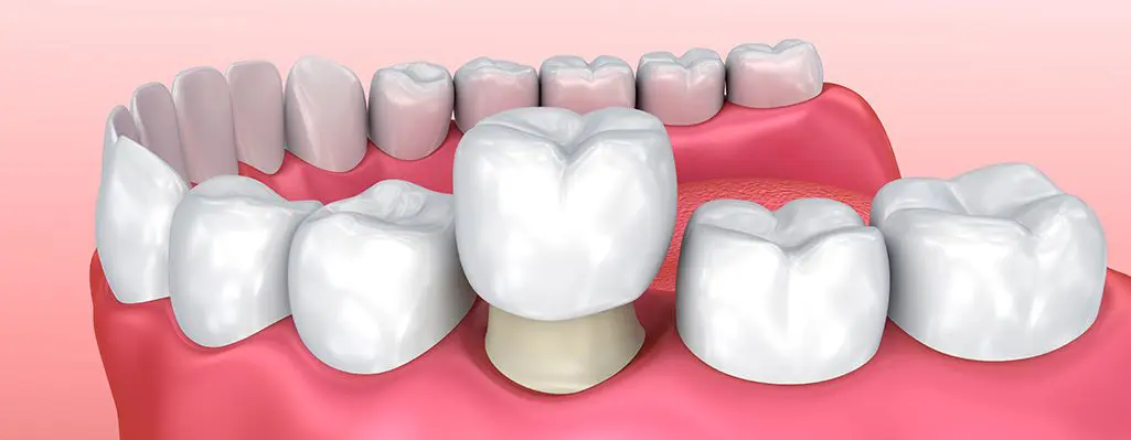 Coroana dentara temporara sau provizorie