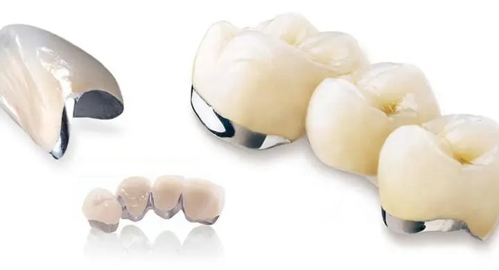 coroana dentara metalo-ceramica