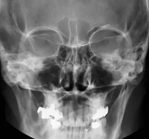 radiografie de craniu sinus