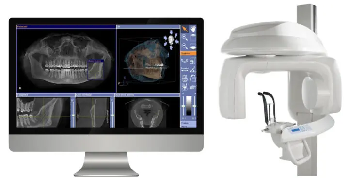 tomografia computerizata pentru implant dentar