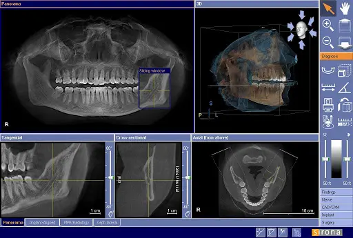 CT tomografie dentara