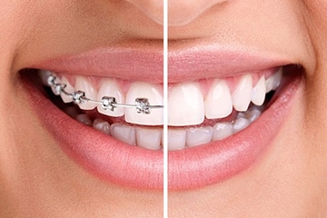 Ortodontie - Aparate dentare