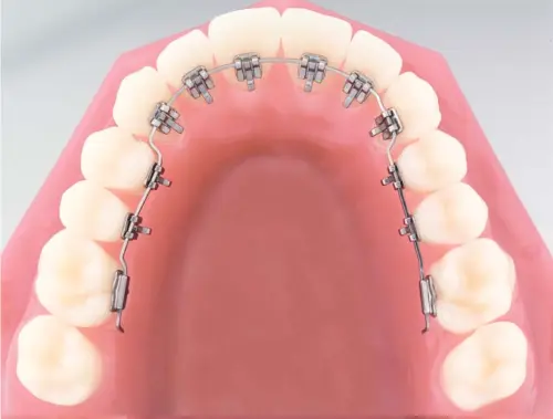 dedication connect abolish Aparat dentar invizibil | Solutia ideala pentru dantura ta!