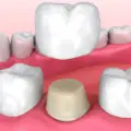 Coroana dentara acrilica: coroane din acrilat sau metalo-acrilice