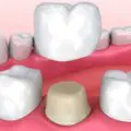Coroana dentara realizata in laborator de tehnicianul dentar
