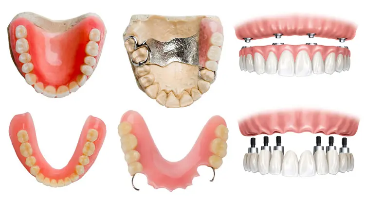 Proteza dentara: tipuri de proteze dentare, preturi si recomandari ...