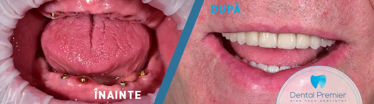 Proteza dentara totala fixa All-on4 si All-on-6 pe implanturi Nobel