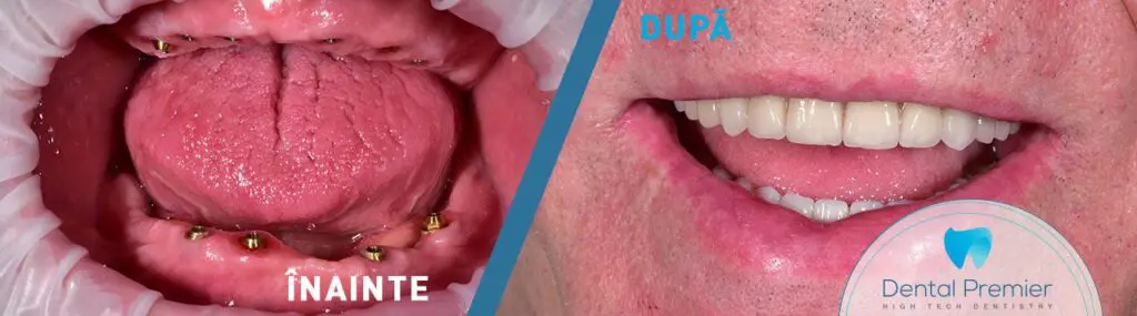 Teeth in a day - Full mouth rehabilitation on dental implants