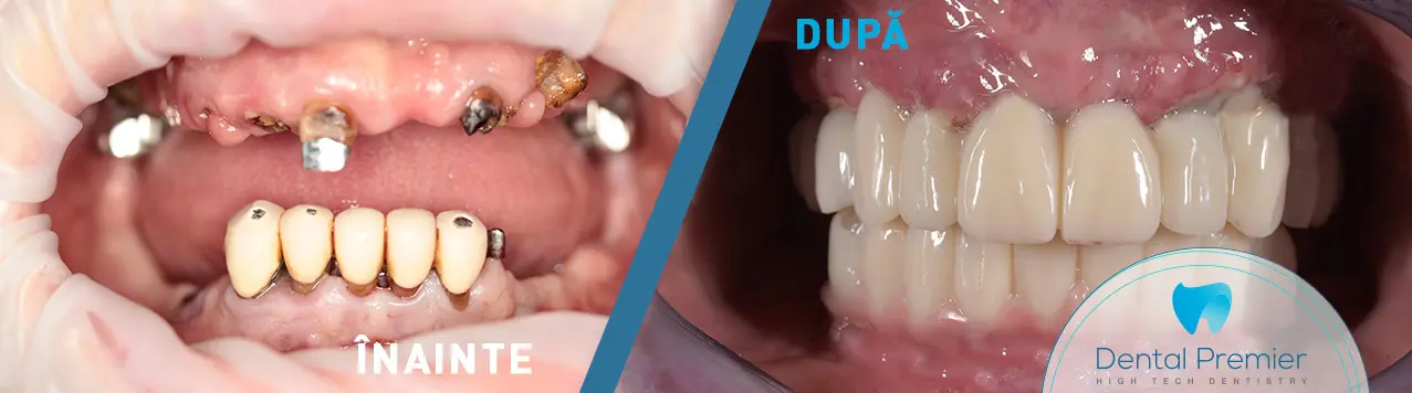 Implanturi dentare Bucuresti si dinti ficsi 24h Maxilar + Mandibula