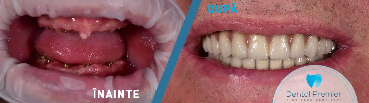 Implanturi dentare + Dinti Ficsi in 24 de ore Maxilar + Mandibula