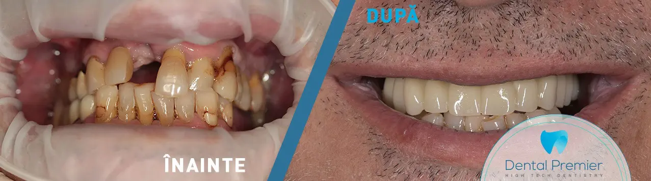 Implant dentar si dinti ficsi fixa in 24ore